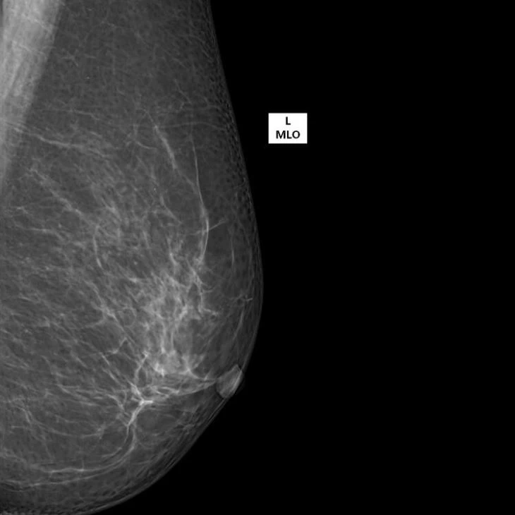 Mammography System Mammography System